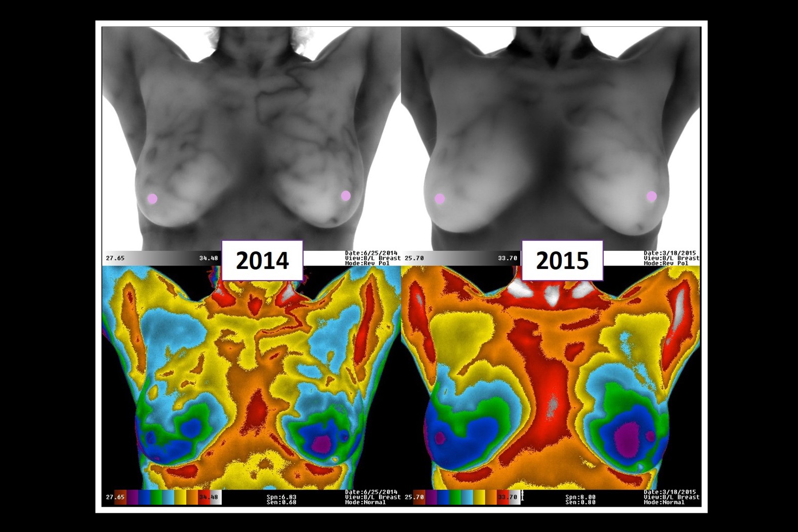 Thermogram Before and After images