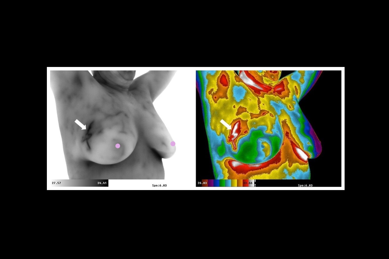 Thermogram Breast Image