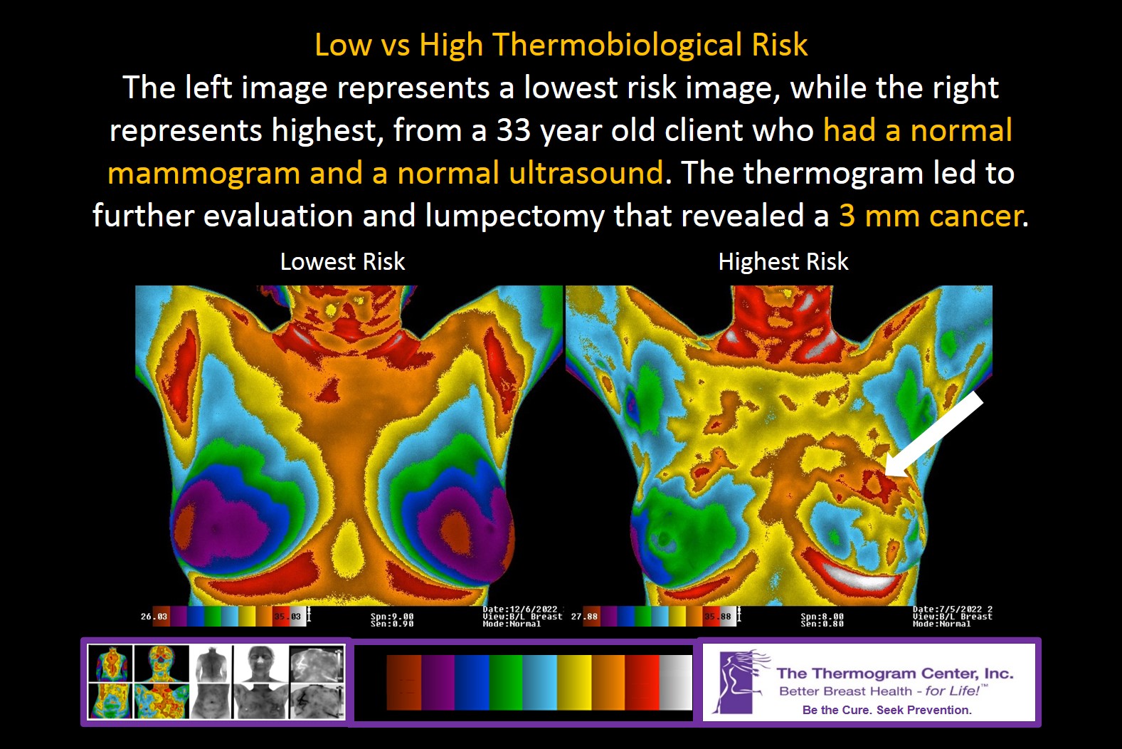 thermogram breast imaging